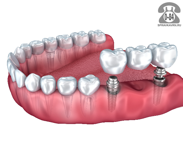 Протезирование зубов